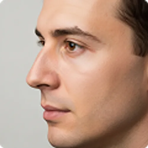 Foto después de la rinoplastia de Juan Pérez